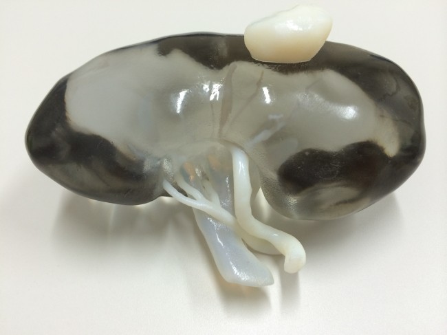 Printed kidney with tumour 1