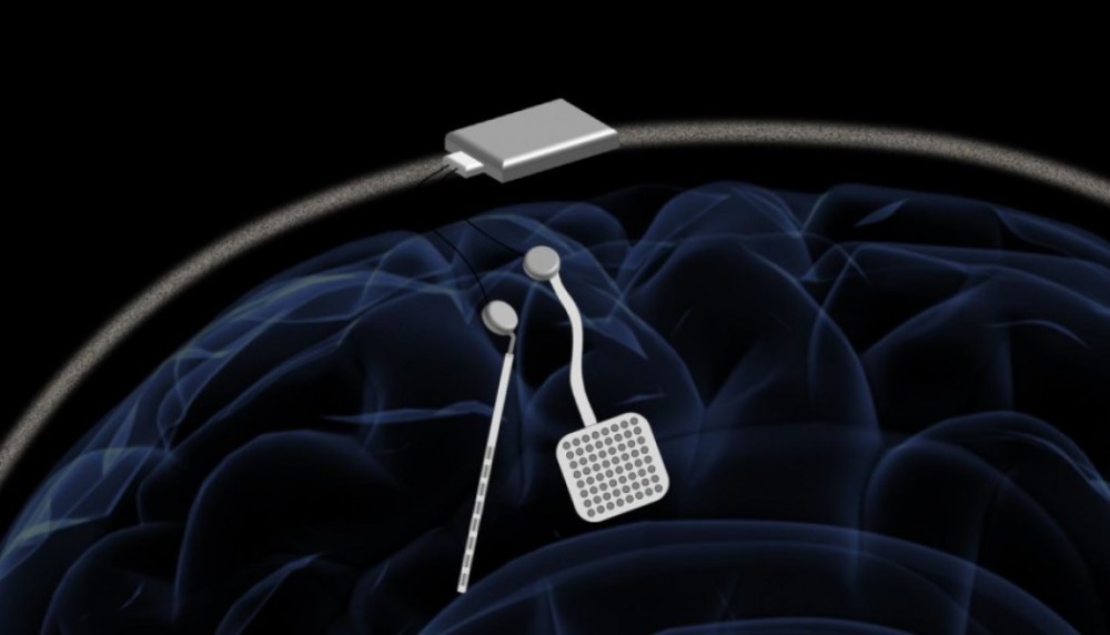 neurostymulacja mozgu class="wp-image-863665" 