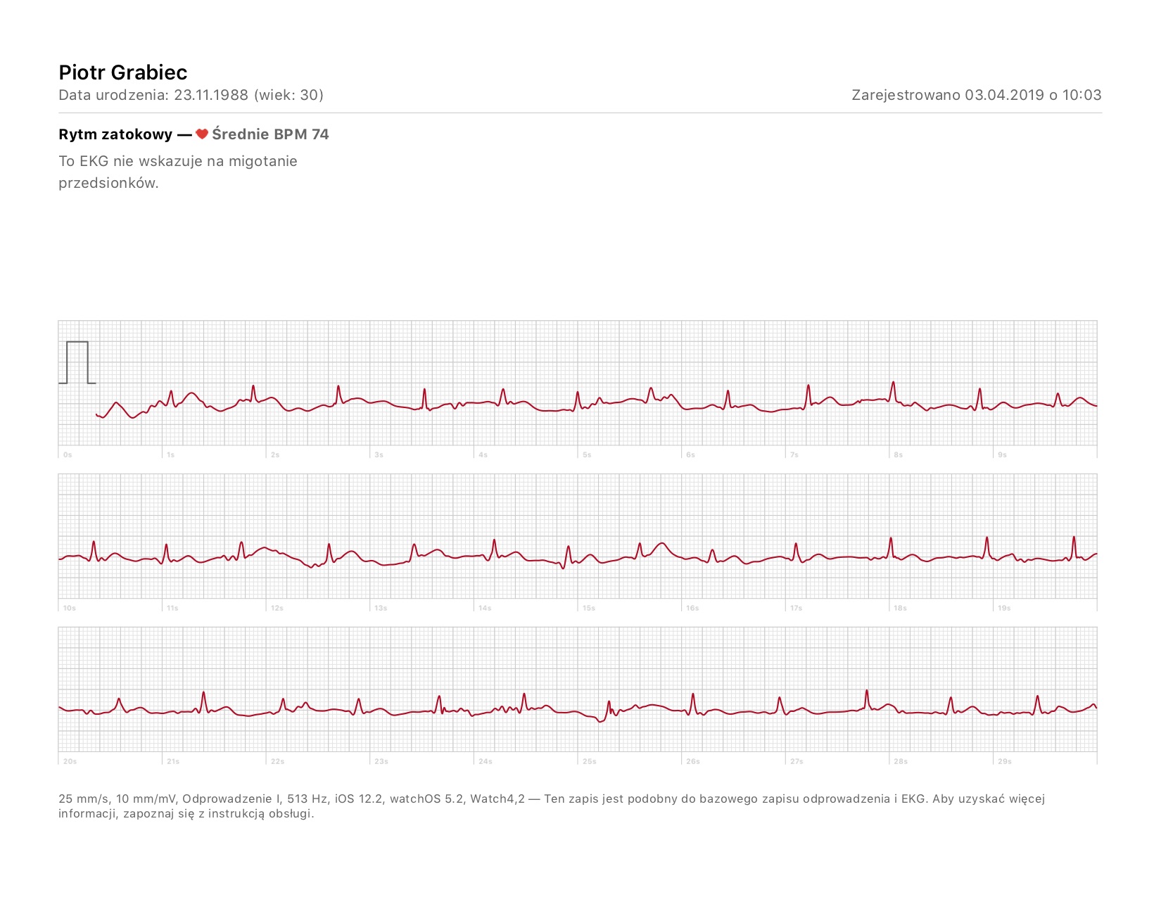 apple watch ekg badanie wyniki porównanie 1 
