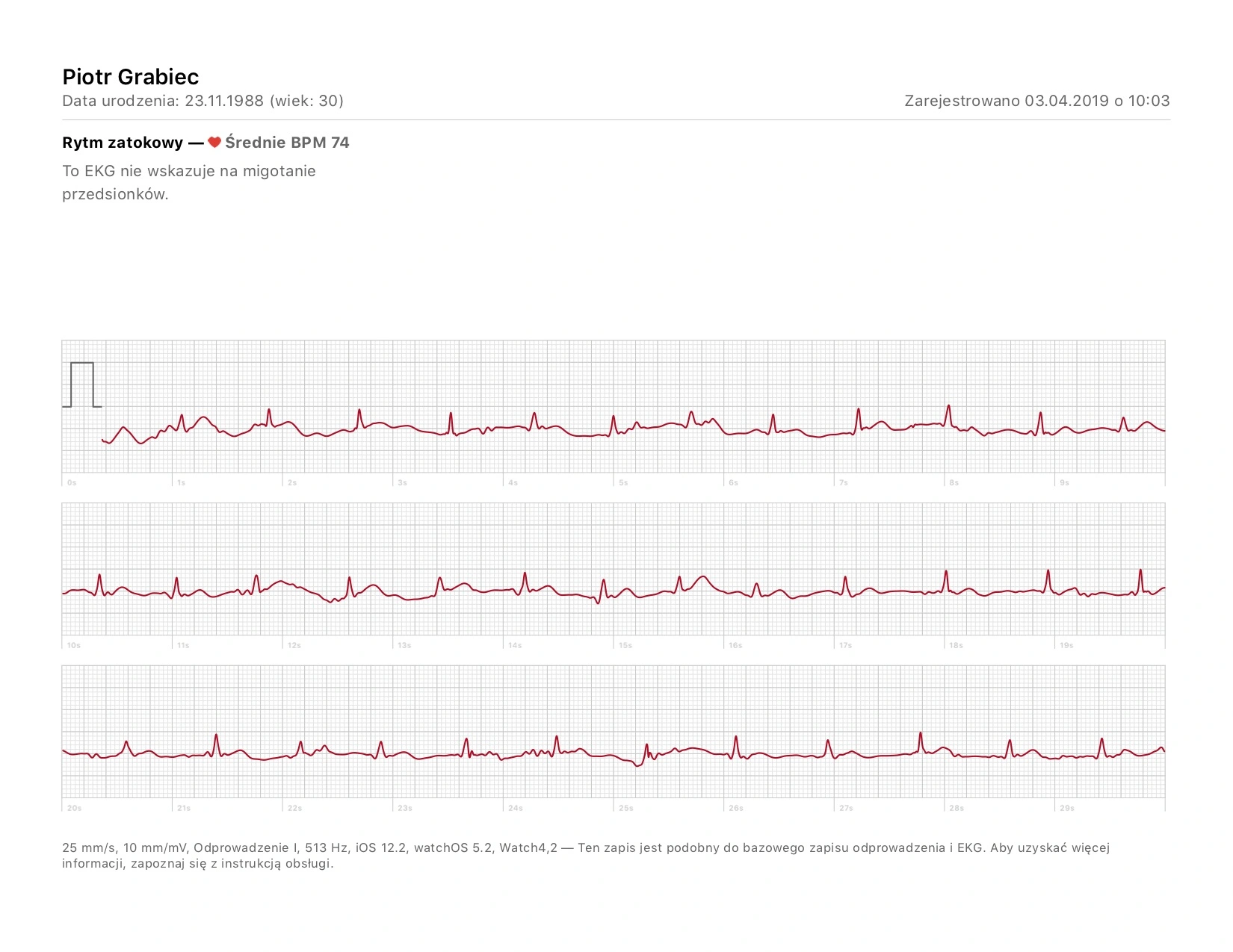 apple watch ekg badanie wyniki porównanie 1