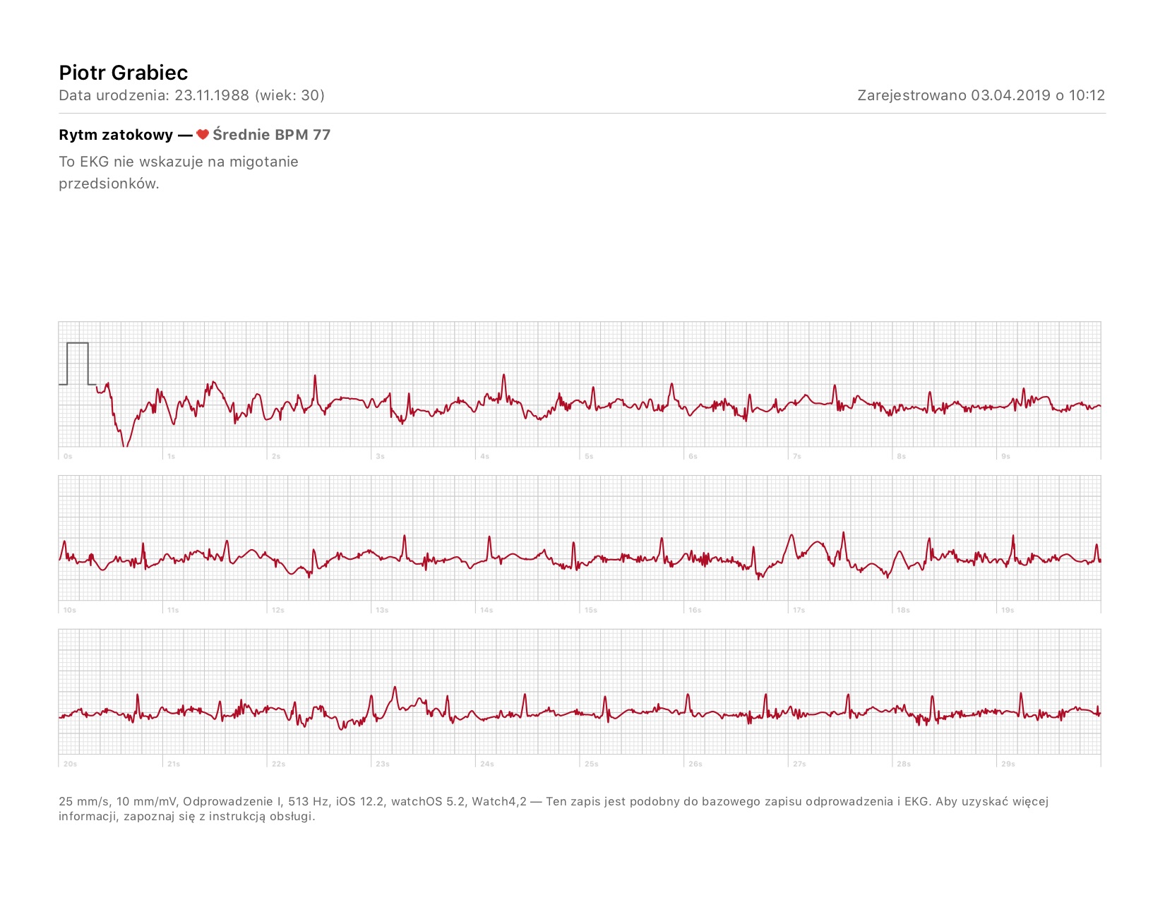 apple watch ekg badanie wyniki porównanie 2 