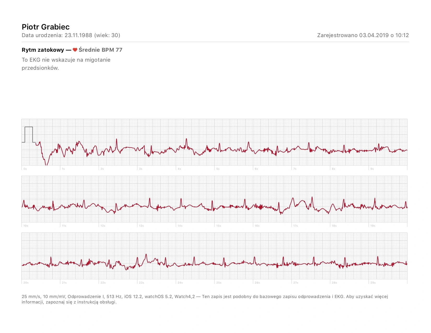 apple watch ekg badanie wyniki porównanie 2