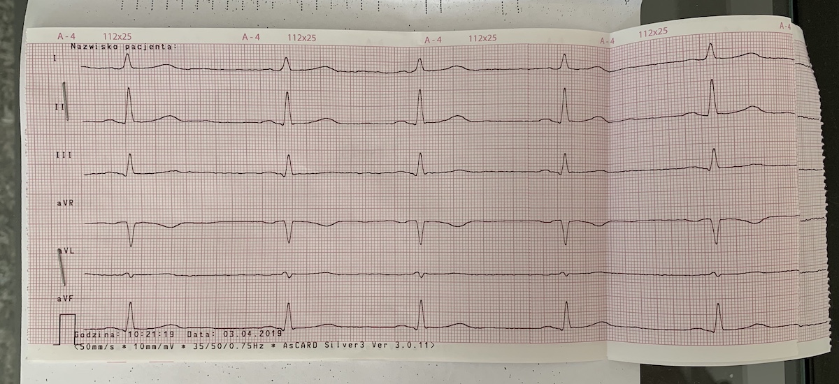 ekg badanie wyniki nie apple watch 1 