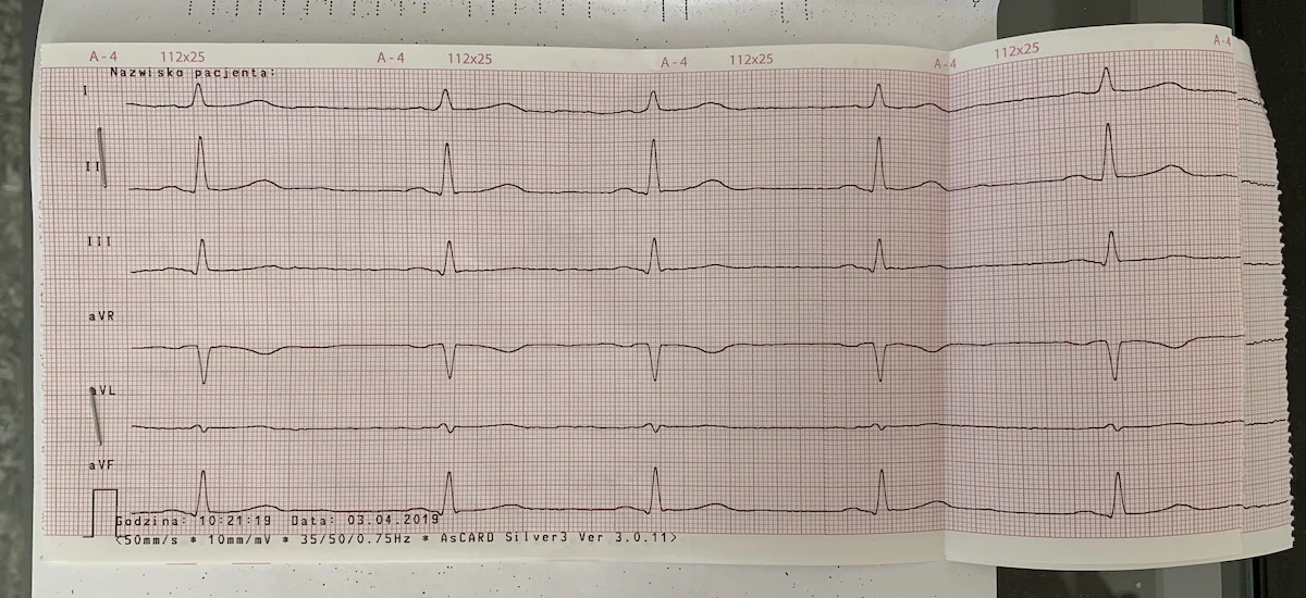 ekg badanie wyniki nie apple watch 1