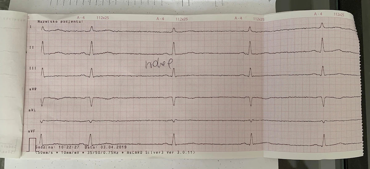 ekg badanie wyniki nie apple watch 2