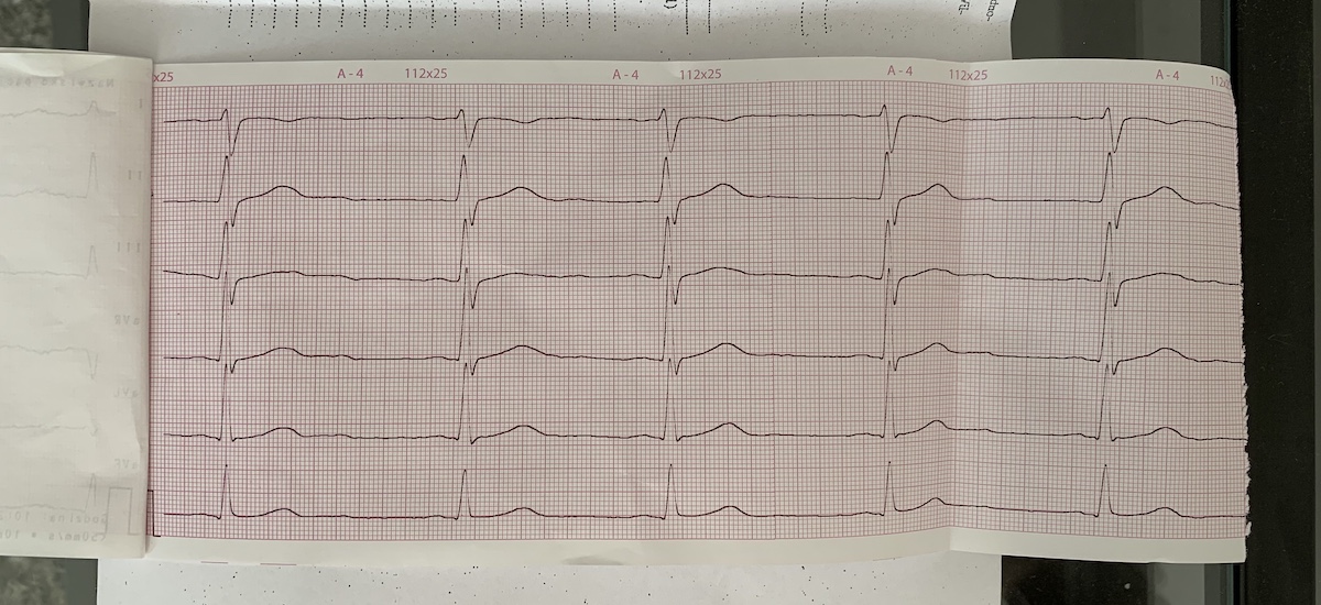 ekg badanie wyniki nie apple watch 3 