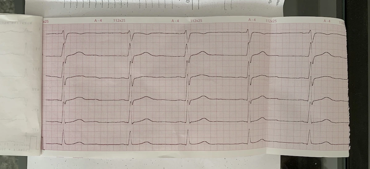 ekg badanie wyniki nie apple watch 3