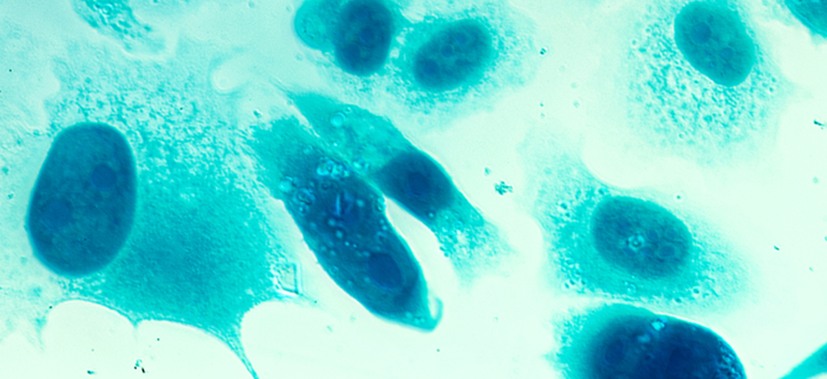 rak-prostaty-leczenie-eksperymentalne-reprogramowane-wirusy.