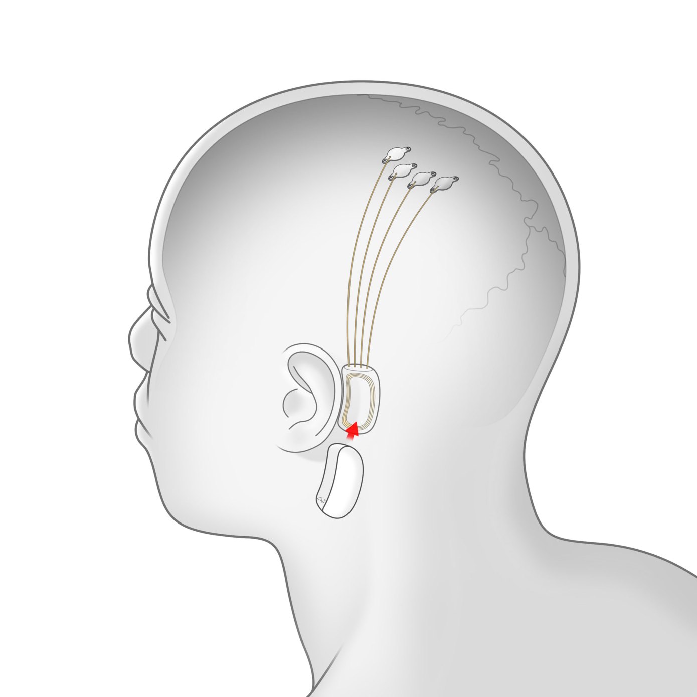 neuralink-elon-musk-zaprezentowal-swoj-pomysl-na-interfejs-mozg-komputer